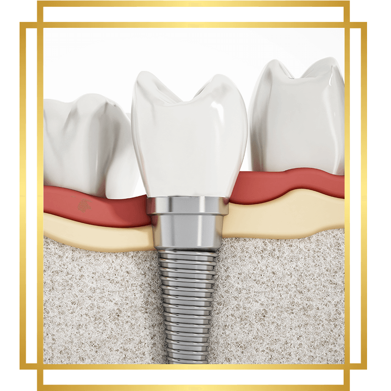 dental implant 3d