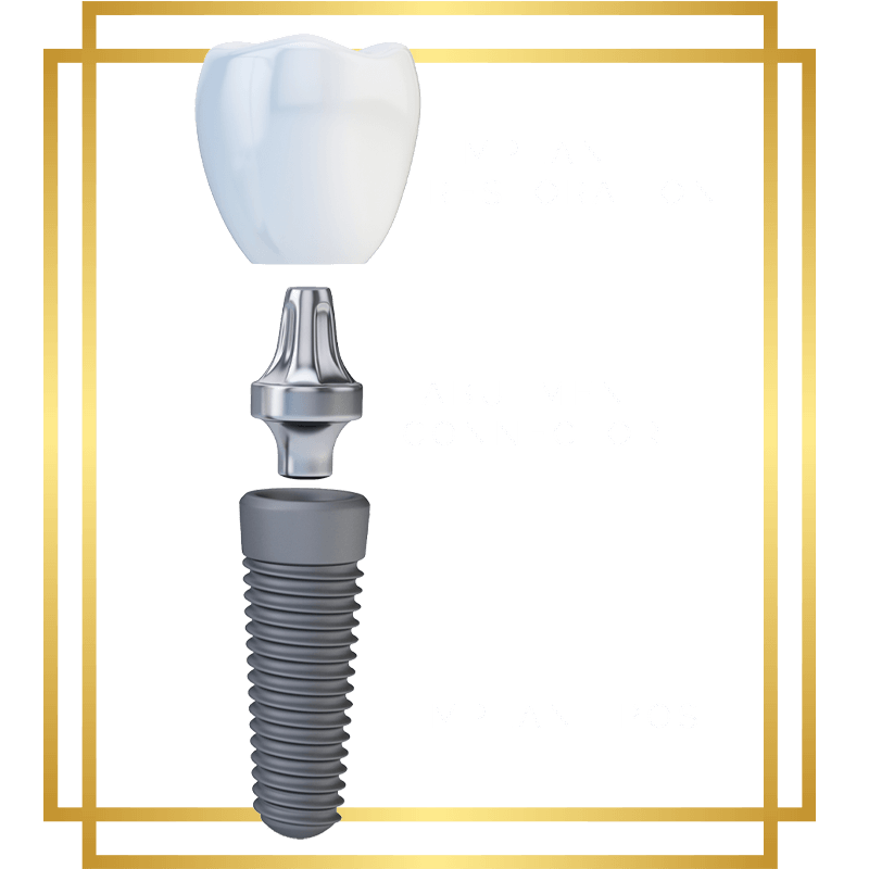 3 parts dental implant