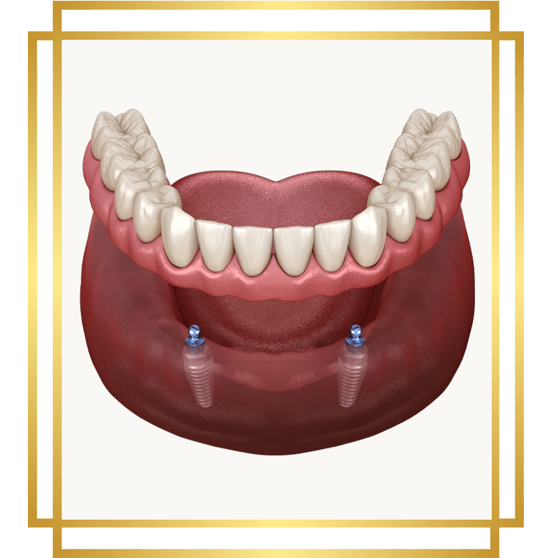 3d implant supported dentures