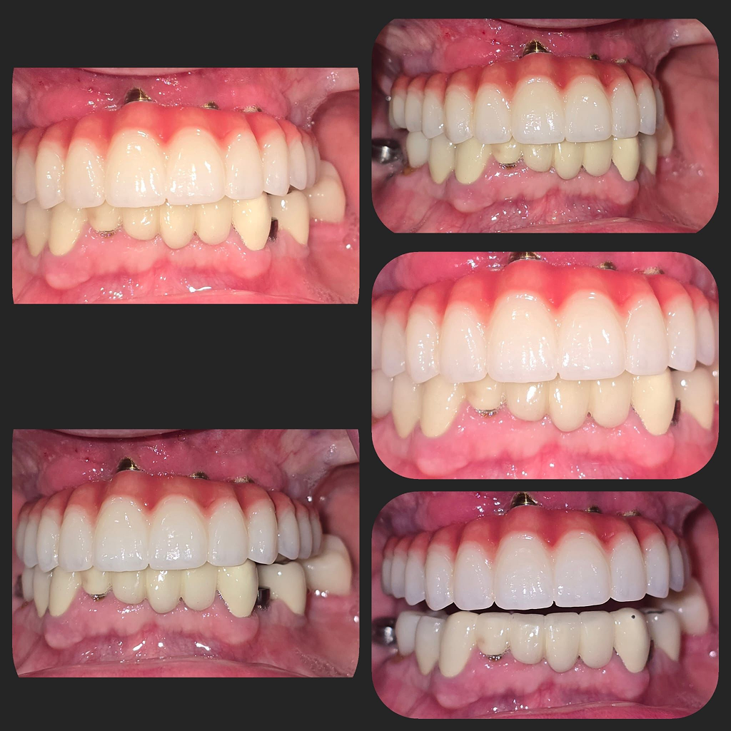 before after multiple