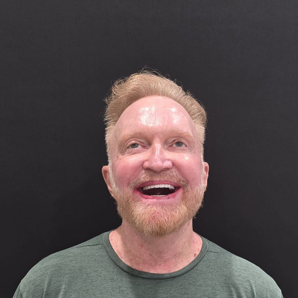 after full arch dental implant patient