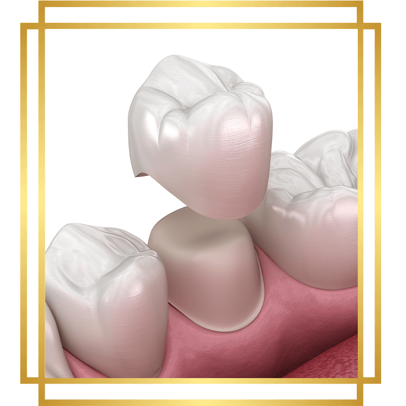 dental crown 3d
