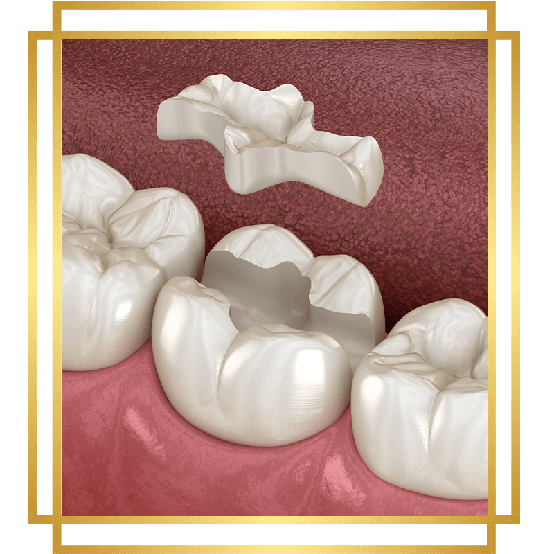 inlay filling 3d real