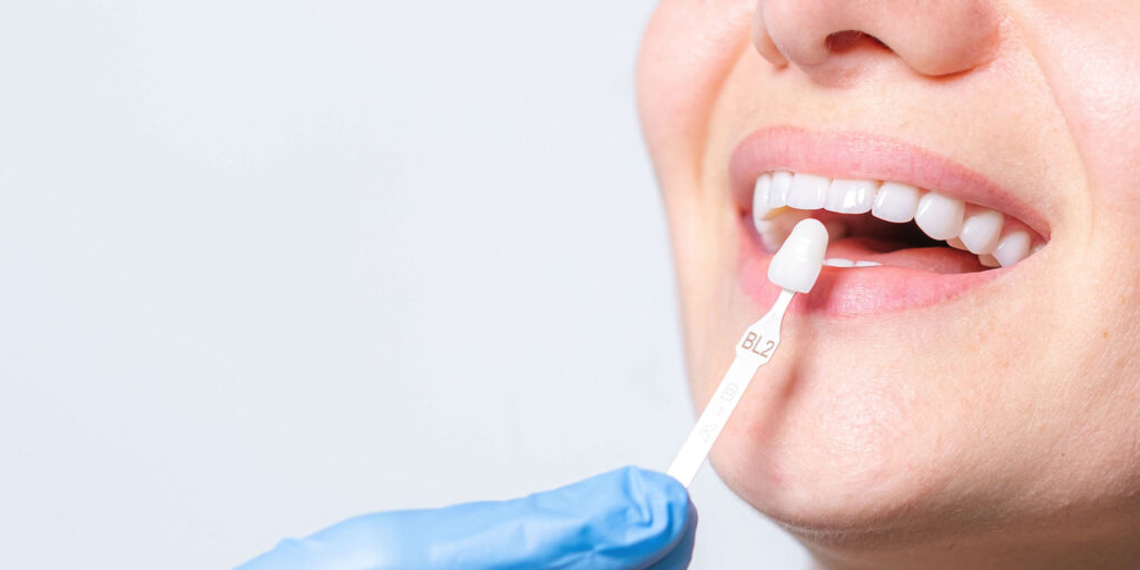 dental veneer being tried hero